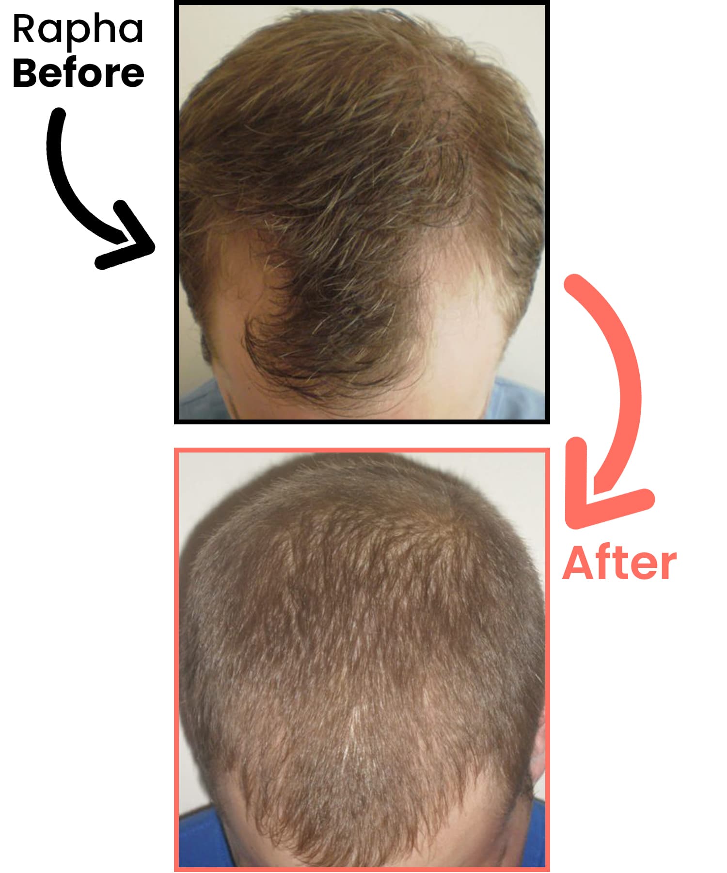 before-after-neu-rapha